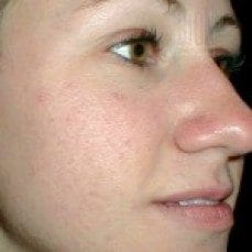 acne system peoria