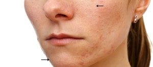Large pores and microdermabrasion